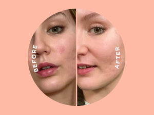 ZitSticka - Killa Kit Model